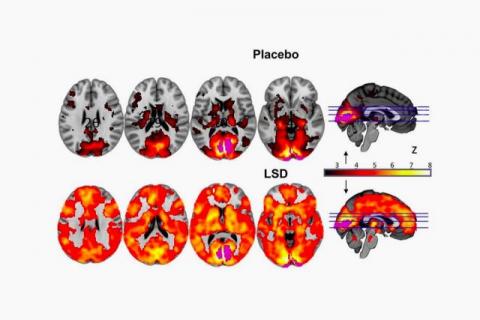 A scientific study to capture images of your brain on LSD