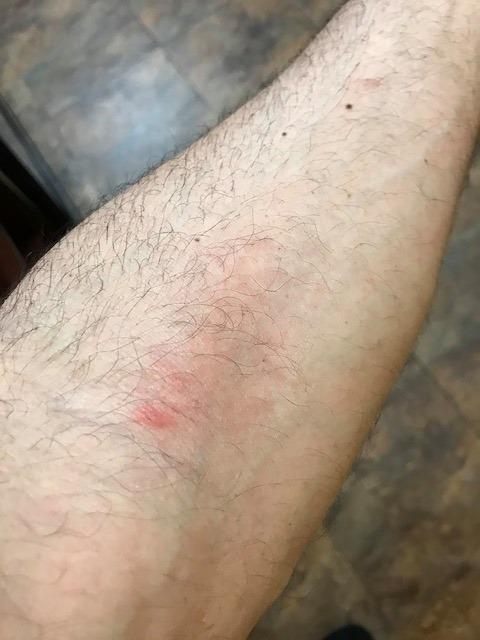 Five days after a bee sting
