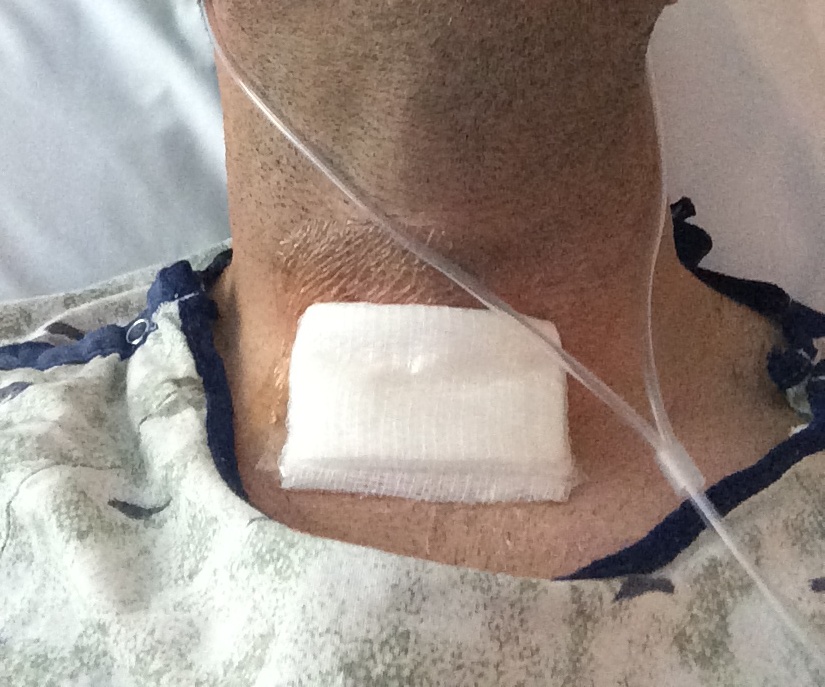 Recovering From A Total Thyroidectomy papillary Thyroid Cancer 