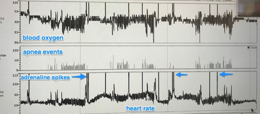 Home sleep study, Image 3