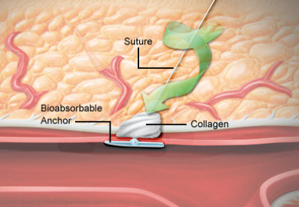 Angio-Seal diagram shows artery, collagen