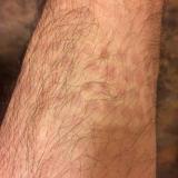 MCAS skin reaction