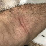 MCAS/MCAD: Skin reaction to tape after bloodwork