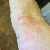 A reaction to a bandage (MCAS, mast cell disease)