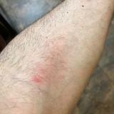 Five days after a bee sting